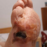 Wound on Diabetic Foot