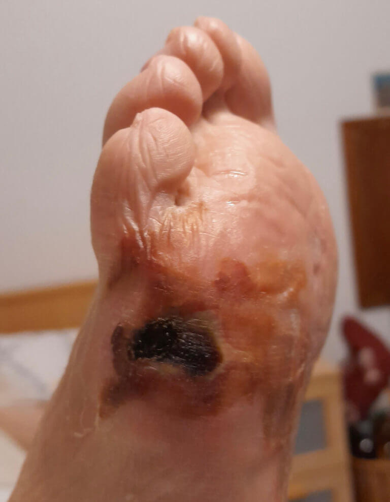 Necrotic ulcer on diabetic foot