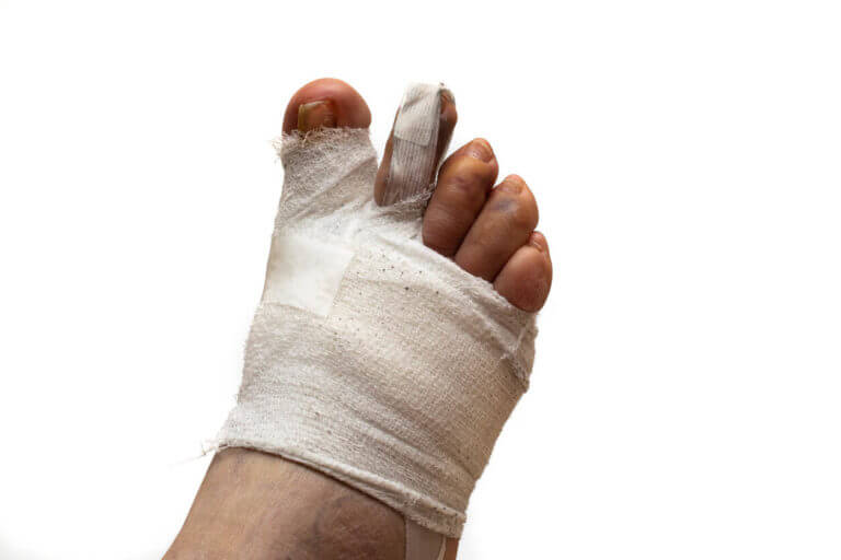 Bandaged foot after hammertoe surgery